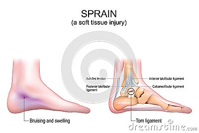 Sprain. A soft tissue injury in the human foot Vector Illustration