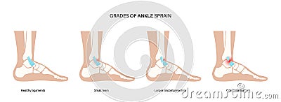 Sprained ankle injury Vector Illustration