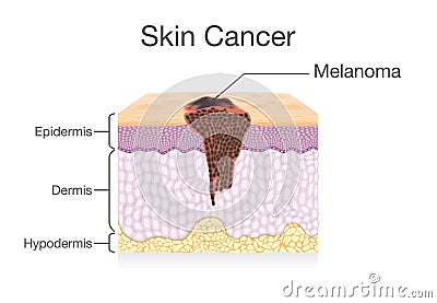 Spreading of Cancer Cell in Human Skin layer. Vector Illustration