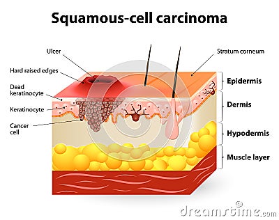 Squamous cell carcinoma Vector Illustration