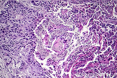 Squamous cell carcinoma of the lung Stock Photo