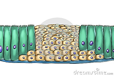 Squamous metaplasia or respiratory epithelium Cartoon Illustration