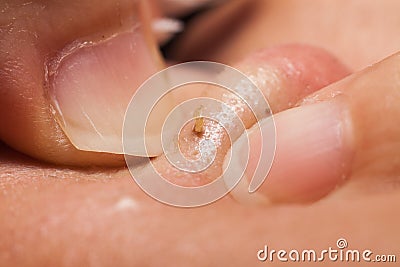 Squeezing Pimple Blackhead with finger nails Stock Photo