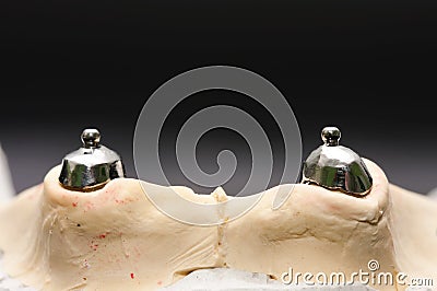 Dental stabilization system Stock Photo