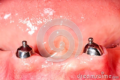 Dental stabilization system Stock Photo