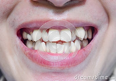 Stacked or overlapping white teeth. Also called crowded teeth Stock Photo