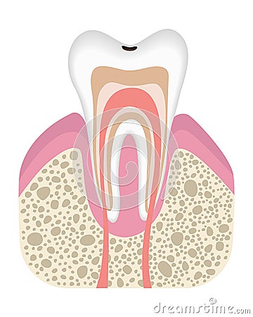 Stage of caries development. Tooth structure in flat style. Tooth decay with enamel. Dental disease realistic vector Vector Illustration