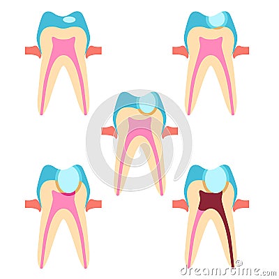 Stage of caries Vector Illustration