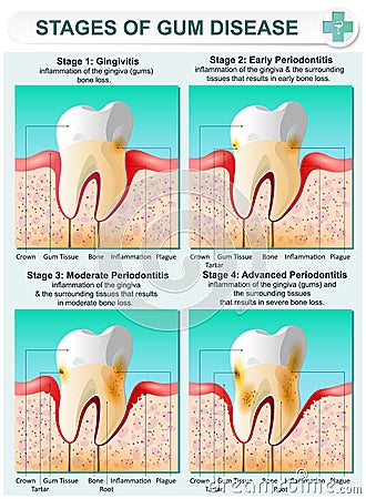 Stage of Gum Disease Vector Illustration