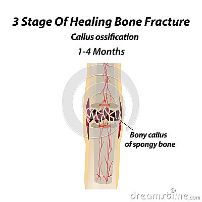 3 Stage Of Healing Bone Fracture. callus ossification. The bone fracture. Infographics. Vector illustration on isolated Vector Illustration