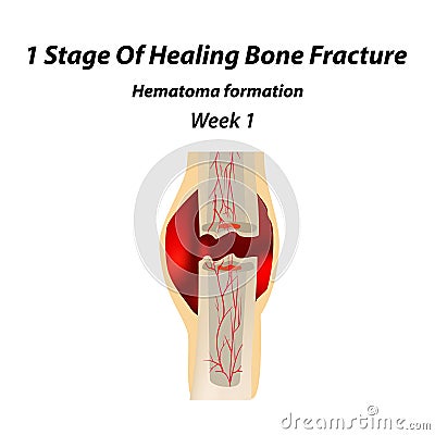 1 Stage Of Healing Bone Fracture. Formation of callus. The bone fracture. Infographics. Vector illustration on isolated Vector Illustration
