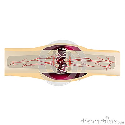 2 Stage Of Healing Bone Fracture. Formation of callus. The bone fracture. Infographics. Vector illustration on isolated Vector Illustration