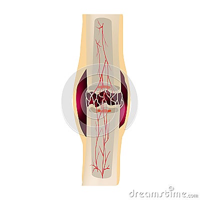 2 Stage Of Healing Bone Fracture. Formation of callus. The bone fracture. Infographics. Vector illustration on isolated Vector Illustration