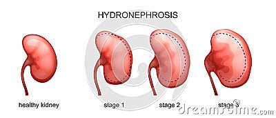 The stage of hydronephrosis Vector Illustration