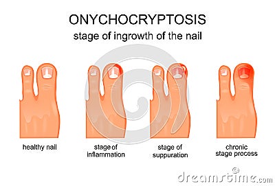 Stage of ingrowth of the nail Vector Illustration