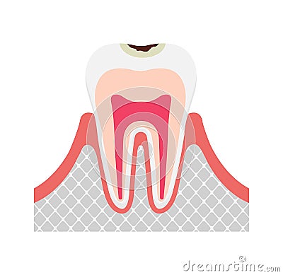 The stage of tooth decay illustration/ Decay in enamel Vector Illustration