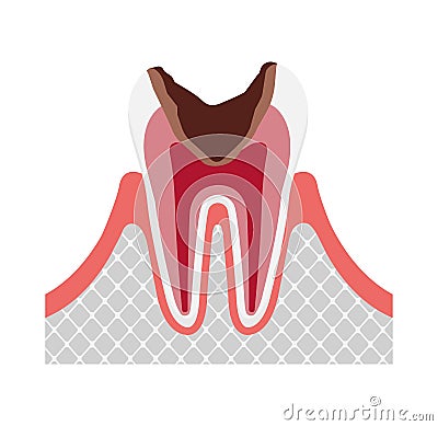 The stage of tooth decay illustration / Decay in pulp Vector Illustration