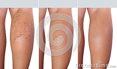 Stage treatment of enlarged veins from extended veins to healthy veins Stock Photo