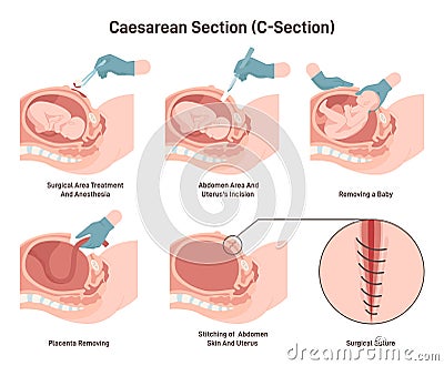 Stages of baby birth with caesarean section. Fetus position during Vector Illustration