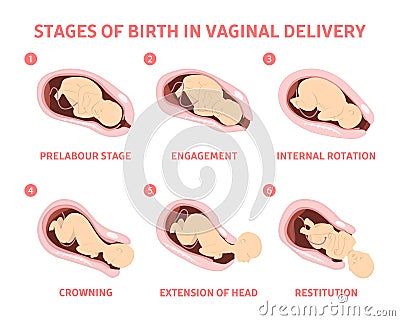 Stages of baby birth in vaginal delivery Vector Illustration