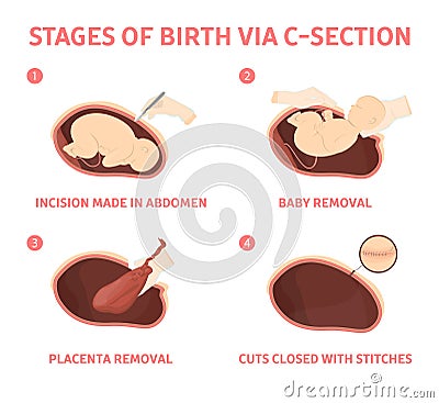 Stages of baby birth via cesarean section Vector Illustration