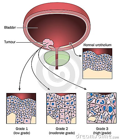 Stages of bladder cancer Vector Illustration