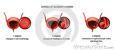 Stages of bladder cancer Vector Illustration