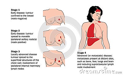 Stages of breast cancer Vector Illustration