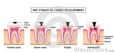 Stages of caries development. Vector Illustration