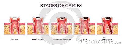 Stages of caries and tooth destruction from spot to periodontitis realistic isolated vector Vector Illustration