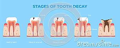 Stages of dental disease. Treatment of the oral cavity. Toothache. Vector illustration Vector Illustration