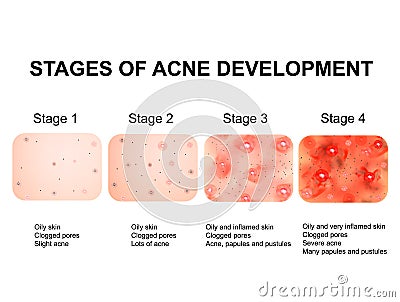 Stages of development of acne. Inflamed skin with scars, acne and pimples. The texture of inflamed skin, and acne and Vector Illustration