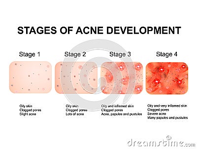 Stages of development of acne. Inflamed skin with scars, acne and pimples. The texture of inflamed skin, and acne and Vector Illustration