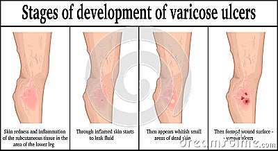 Stages of development of varicose ulcers Vector Illustration