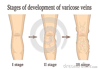 Stages of development of varicose veins Vector Illustration