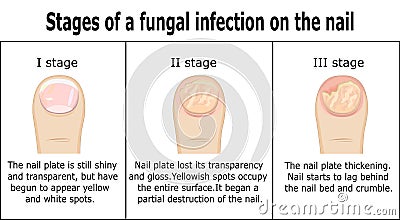 Stages of a fungal infection on the nail Vector Illustration