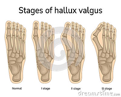 Stages of hallux valgus Vector Illustration