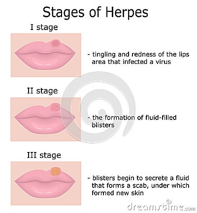 Stages of Herpes Vector Illustration