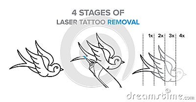 4 Stages of laser tattoo removal illustration, vector icons Vector Illustration