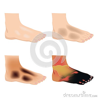 Stages of limb ischemia. Gangrene of the legs. Vector Illustration