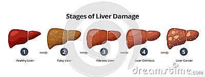 Stages of liver damage from healthy, fatty liver, fibrosis, cirrhosis to liver cancer. Medical infographic, liver Vector Illustration