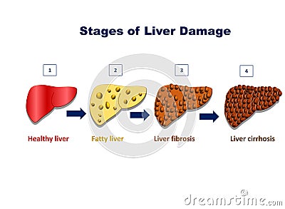 Stages of liver damage, liver injury fatty liver, liver fibrosis, liver cirrhosis Vector Illustration