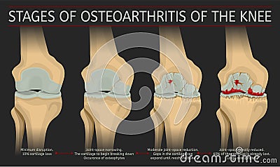 Stages of osteoarthritis of the knee Vector Illustration