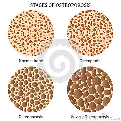 Stages of osteoporosis. Vector Illustration