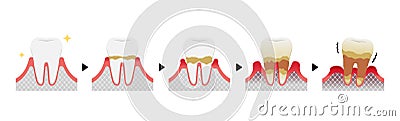 The stages of periodontitis disease vector illustration Vector Illustration