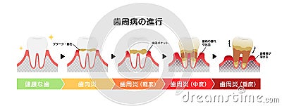 The stages of periodontitis disease vector illustration Vector Illustration