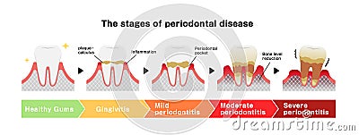 The stages of periodontitis disease illustration Vector Illustration