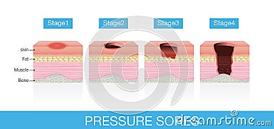 Stages of Pressure Sores Vector Illustration