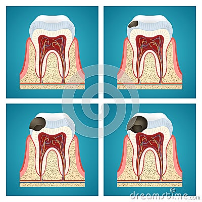 Stages progress caries on human teeth Stock Photo