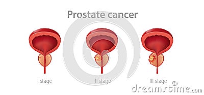 Stages prostate cancer. Disruption of male gland with its growth into malignant tumor impaired reproductive function. Vector Illustration